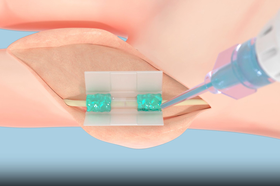 La plataforma de Tissium consta de polímeros biocompatibles (la sustancia azul gelatinosa que se muestra en esta representación) que se adaptan a los tejidos y a una cámara impresa en 3D (el tubo transparente en el centro). Créditos: Cortesía de Tissium.